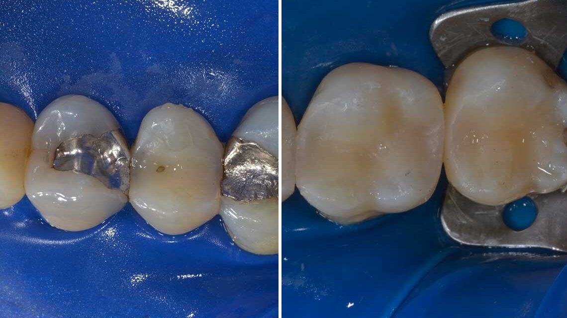 Conservativa Amalgama Caso Clinico