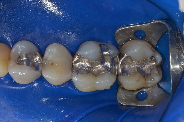 Conservativa Amalgama Prima