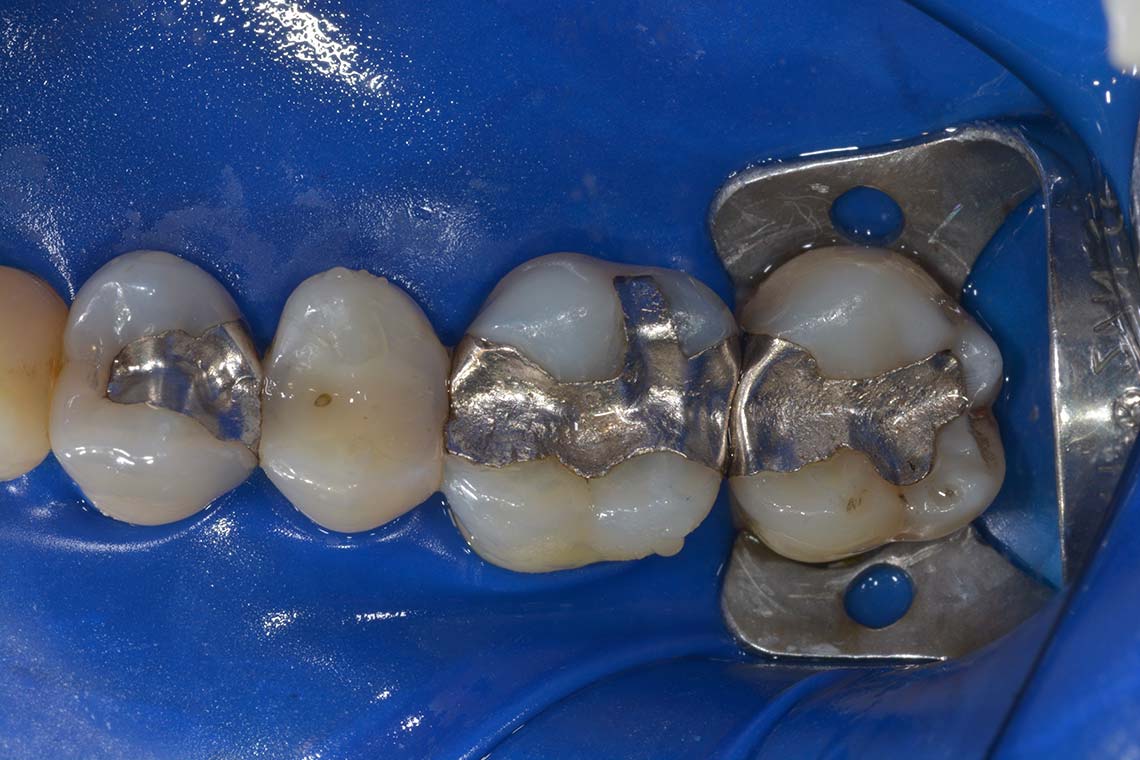 Conservativa Amalgama Prima