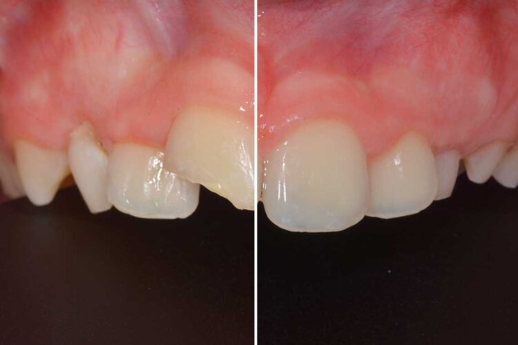 Conservativa Incisivo Caso Clinico