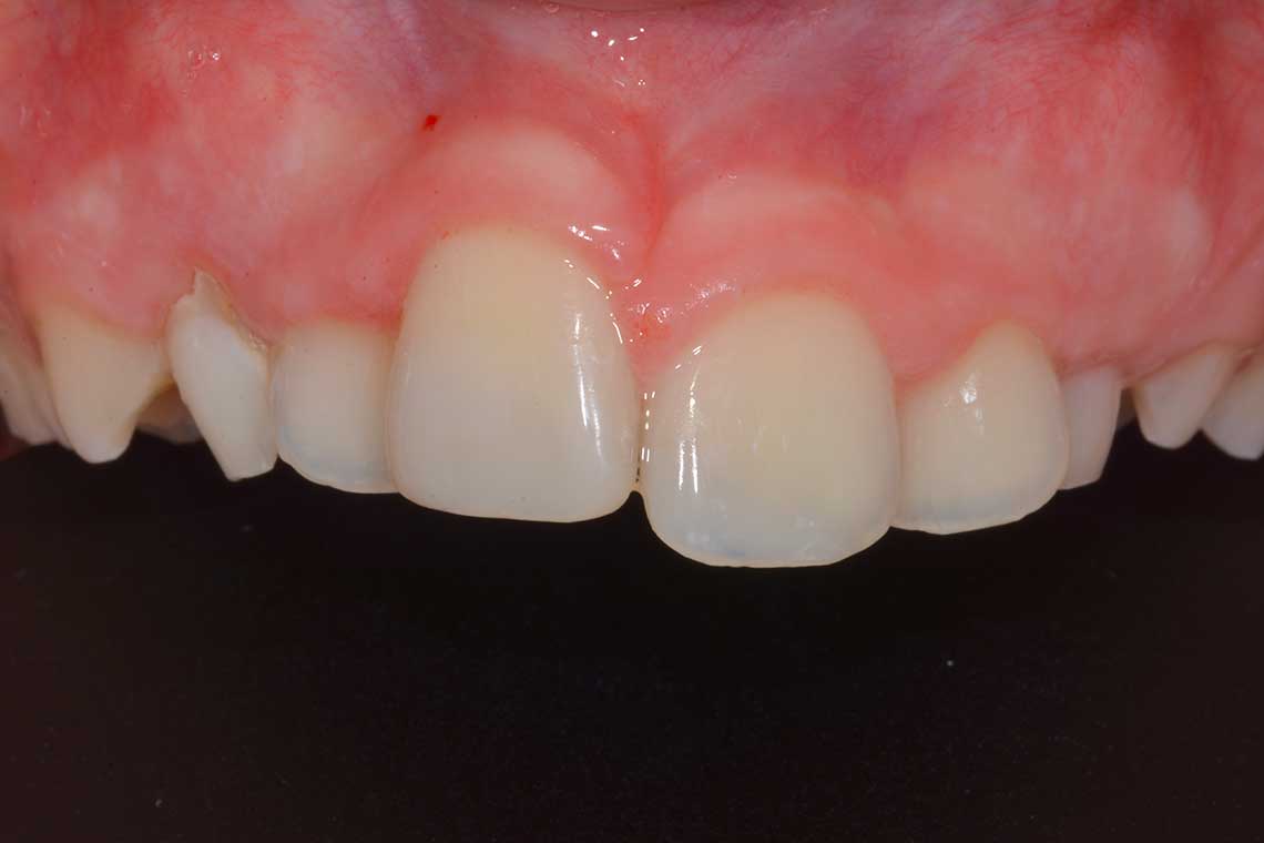 Conservativa Incisivo Dopo