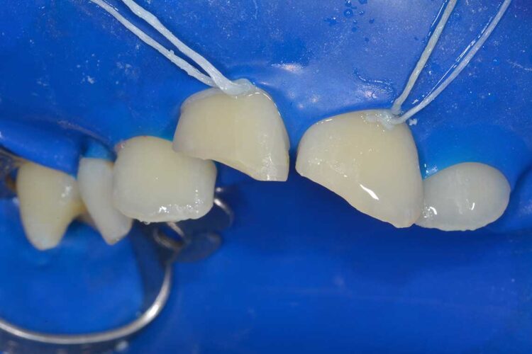 Conservativa Incisivo Durante