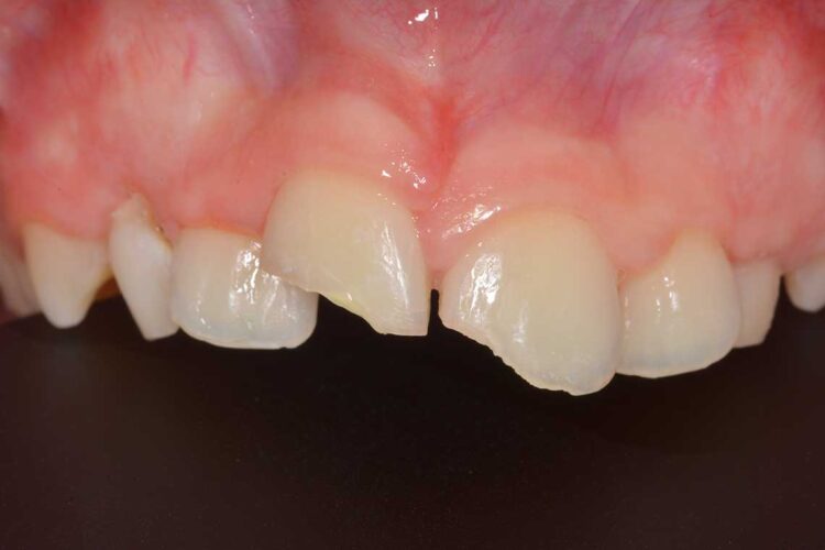 Conservativa Incisivo Prima