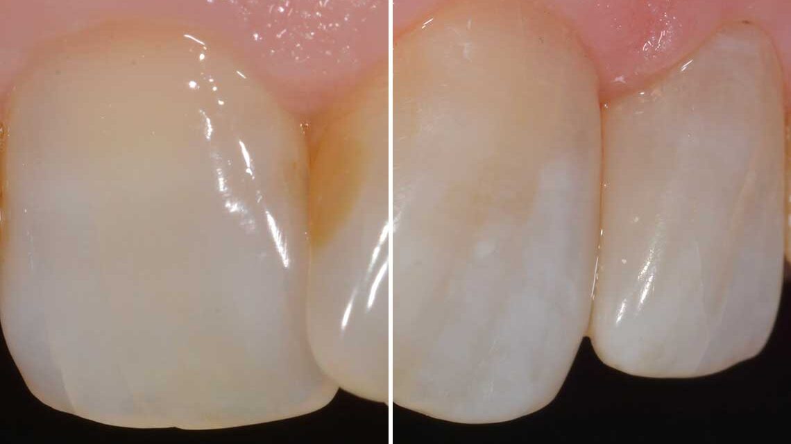 Conservativa Otturazione Caso Clinico