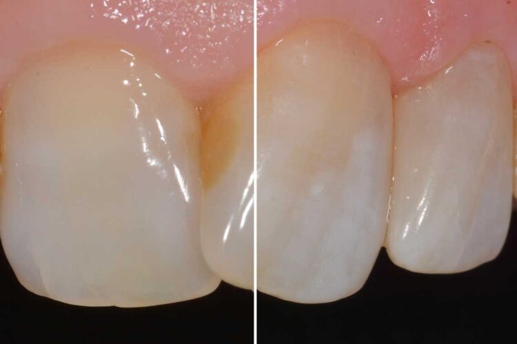 Conservativa Otturazione Caso Clinico