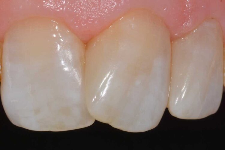 Conservativa Otturazione Dopo