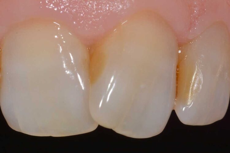 Conservativa Otturazione Prima