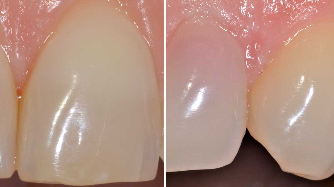 Conservativa Sbiancamento Caso Clinico