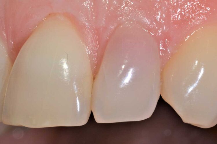 Conservativa Sbiancamento Dopo