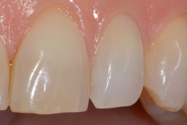 Conservativa Sbiancamento Prima