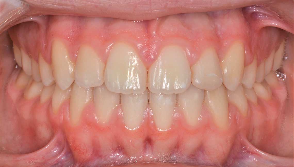 Ortdonzia Adolescente Dopo