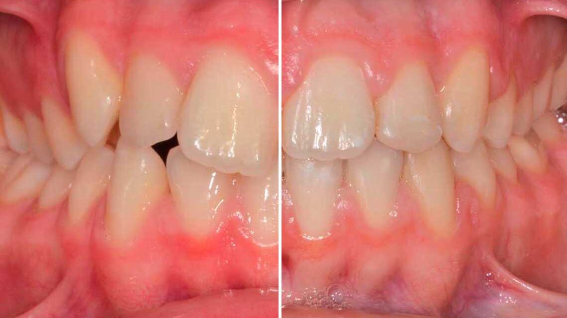 Ortdonzia Adolescenti Caso Clinico1