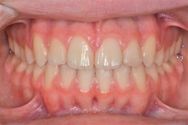 Ortdonzia Adolescenti Caso1 Dopo1