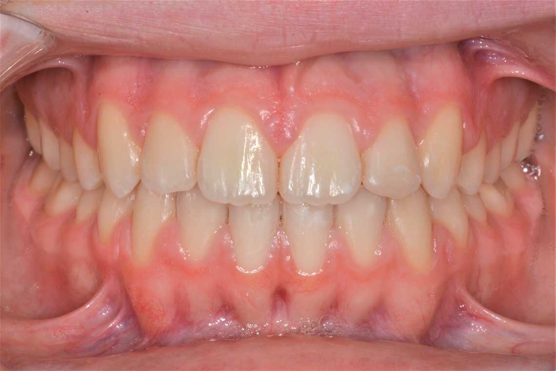 Ortdonzia Adolescenti Caso1 Dopo1