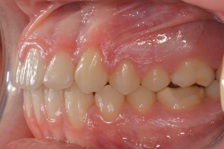 Ortdonzia Adolescenti Caso1 Dopo2