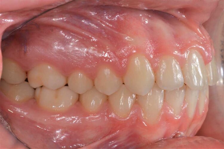 Ortdonzia Adolescenti Caso1 Dopo3