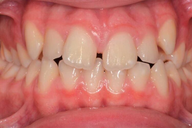 Ortdonzia Adolescenti Caso1 Prima1