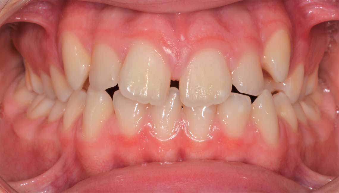 Ortdonzia Adolescenti Caso1 Prima1