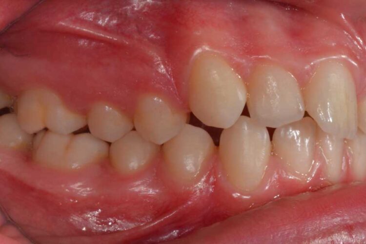 Ortdonzia Adolescenti Caso1 Prima3