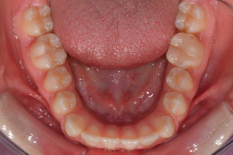 Ortdonzia Adolescenti Caso1 Prima5