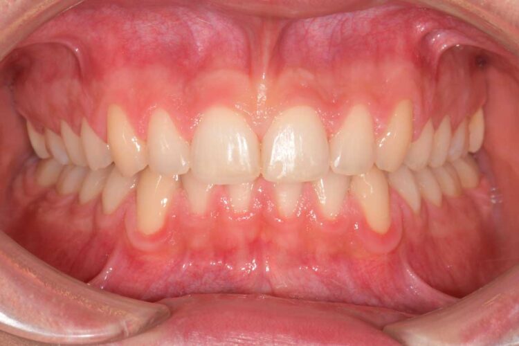 Ortdonzia Adolescenti Caso2 Dopo1