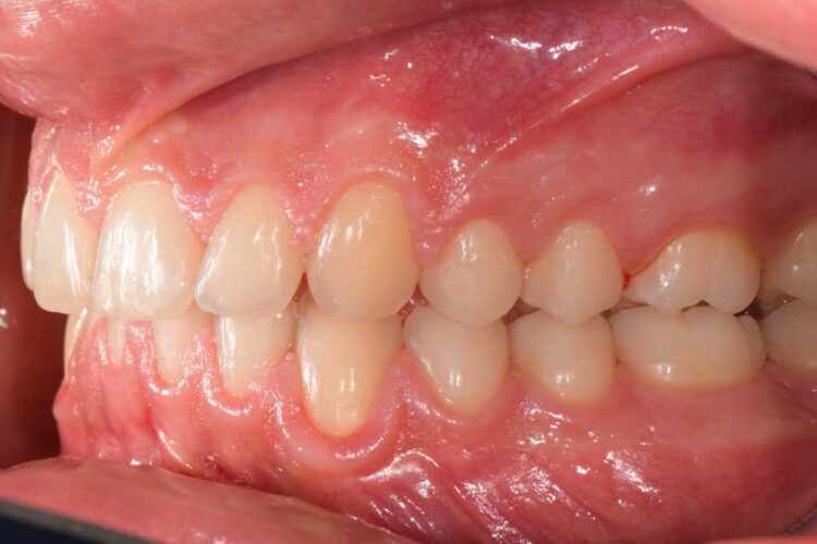 Ortdonzia Adolescenti Caso2 Dopo2