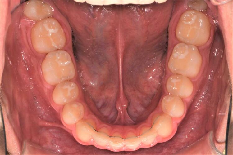 Ortdonzia Adolescenti Caso2 Dopo5