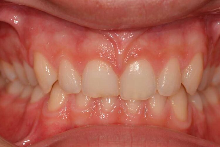 Ortdonzia Adolescenti Caso2 Prima1