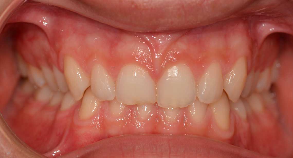 Ortdonzia Adolescenti Caso2 Prima1