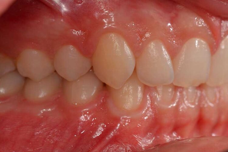 Ortdonzia Adolescenti Caso2 Prima3