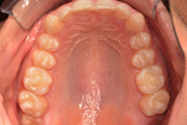 Ortdonzia Adolescenti Caso2 Prima4