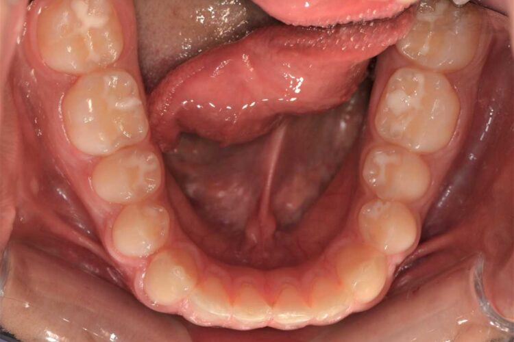 Ortdonzia Adolescenti Caso2 Prima5