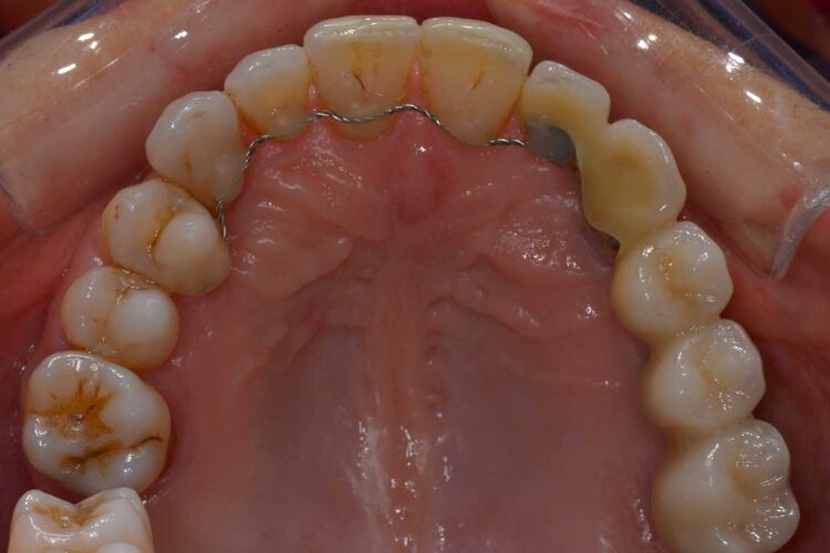 Ortdonzia Adulto Caso1 Dopo4