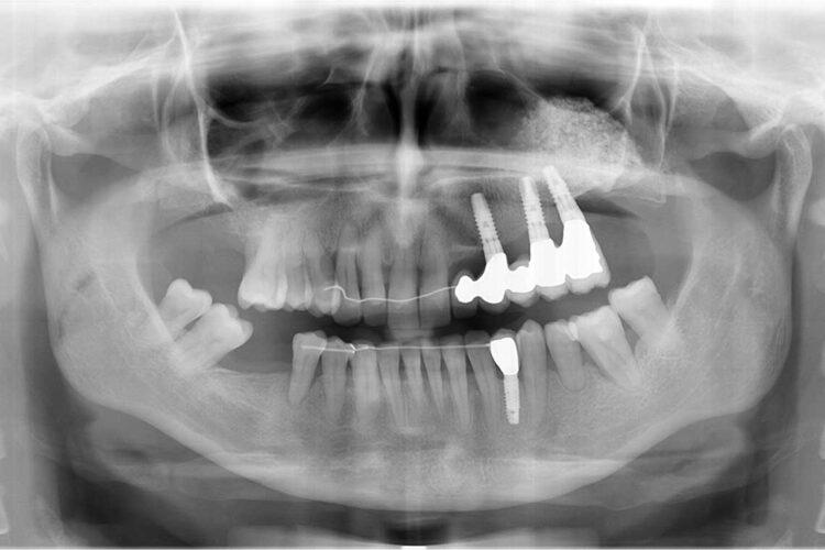Ortdonzia Adulto Caso1 Dopo6