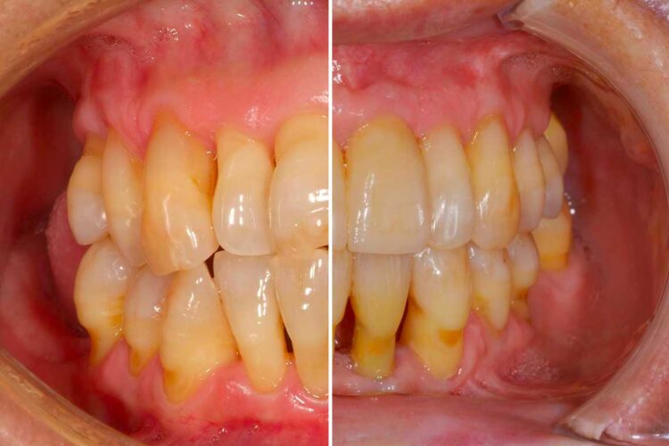 Ortdonzia Adulto Caso2