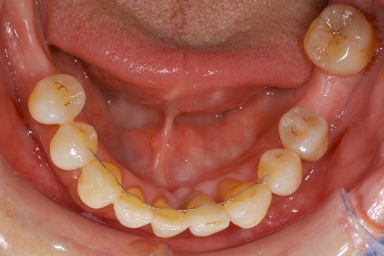 Ortdonzia Adulto Caso2 Dopo5