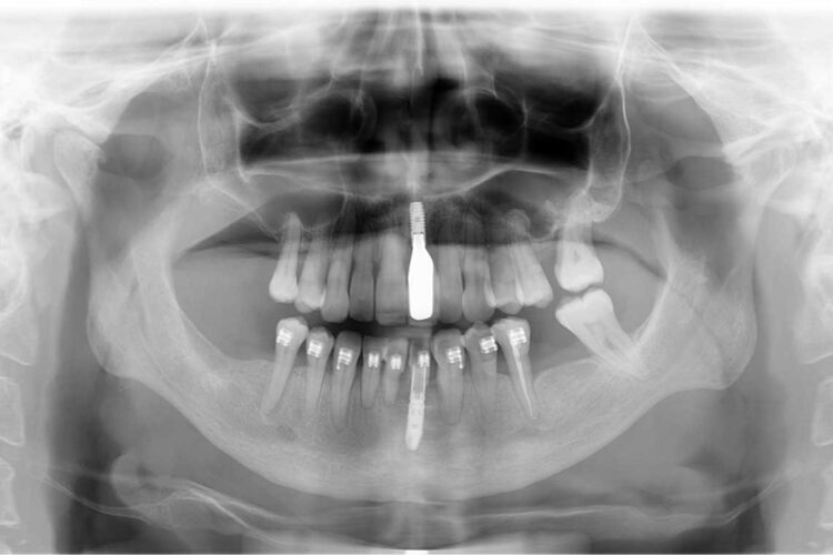 Ortdonzia Adulto Caso2 Dopo6