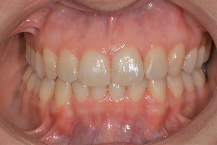 Ortodonzia Allineatori Caso Clinico1 Dopo