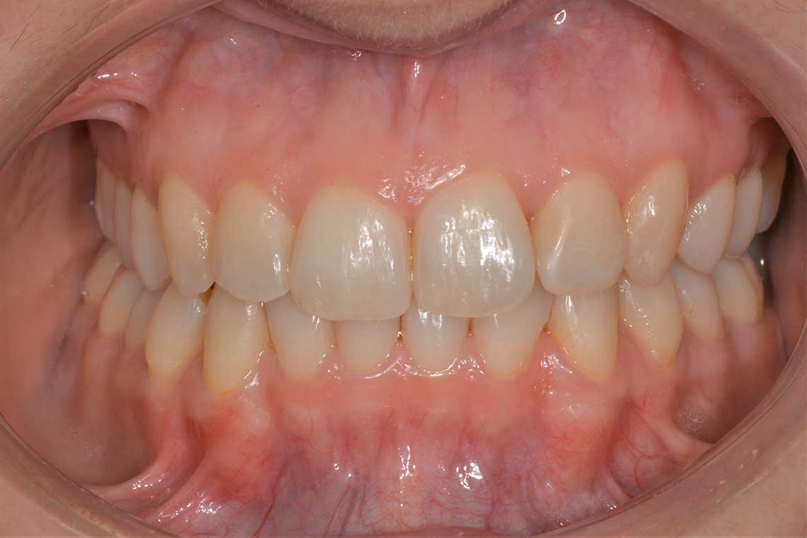 Ortodonzia Allineatori Caso Clinico1 Dopo