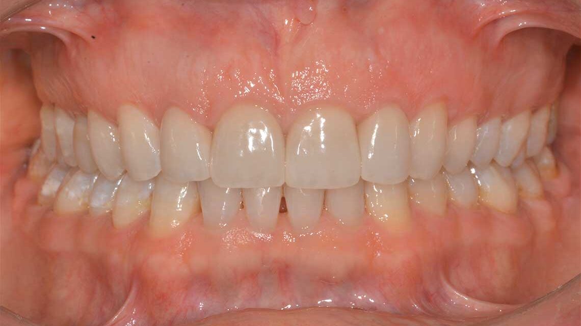 Ortodonzia Allineatori Caso Clinico1 Dopo1