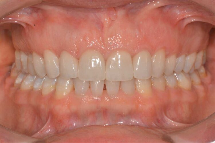 Ortodonzia Allineatori Caso Clinico1 Dopo1