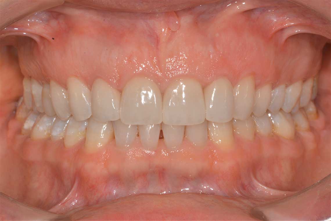 Ortodonzia Allineatori Caso Clinico1 Dopo1