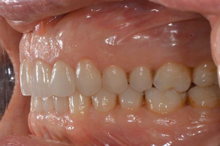 Ortodonzia Allineatori Caso Clinico1 Dopo2