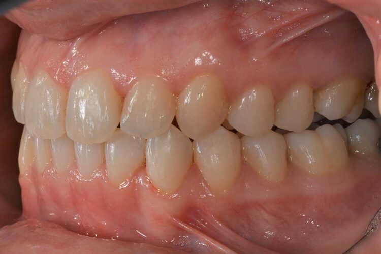 Ortodonzia Allineatori Caso Clinico1 Dopo2