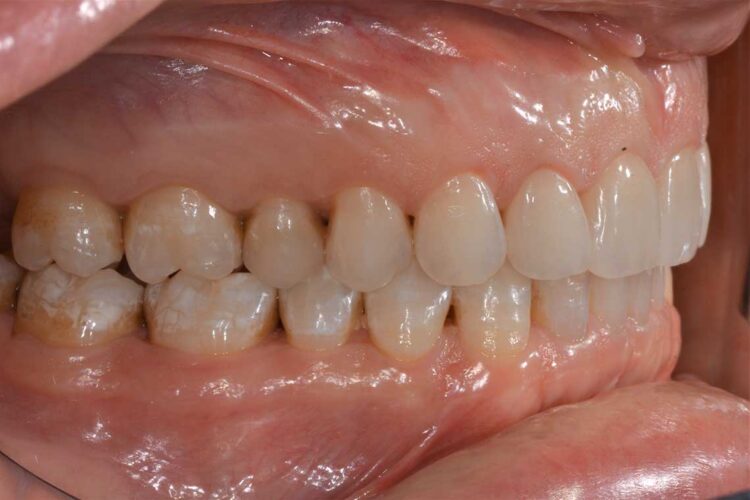 Ortodonzia Allineatori Caso Clinico1 Dopo3