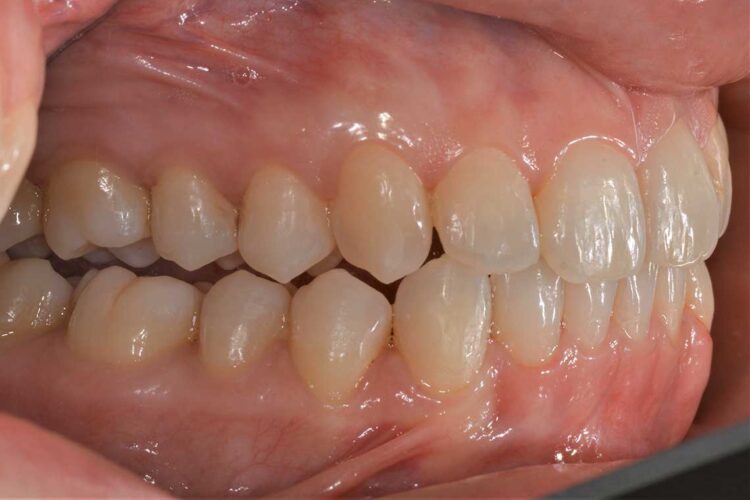 Ortodonzia Allineatori Caso Clinico1 Dopo3