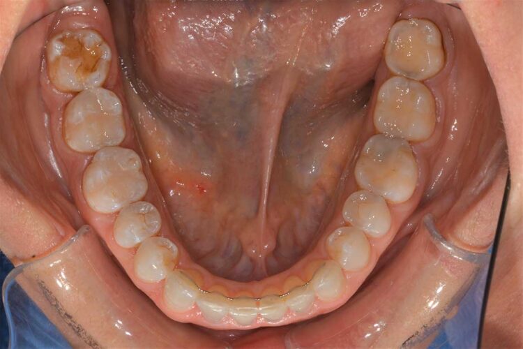 Ortodonzia Allineatori Caso Clinico1 Dopo5