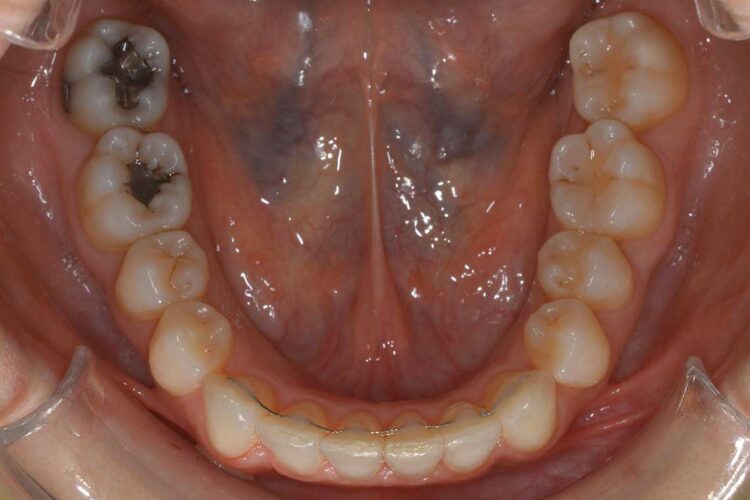 Ortodonzia Allineatori Caso Clinico1 Dopo5