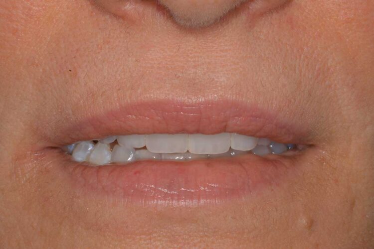 Ortodonzia Allineatori Caso Clinico1 Dopo6