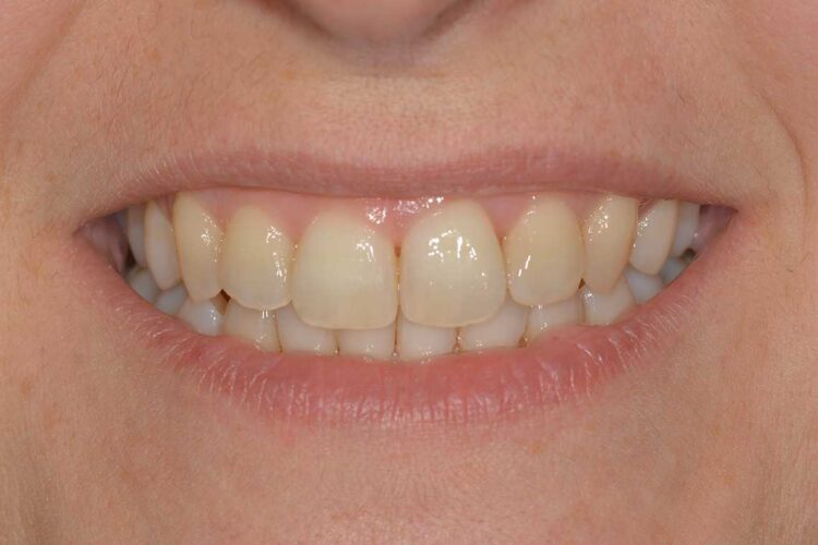 Ortodonzia Allineatori Caso Clinico1 Dopo6